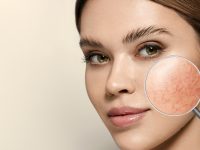 magnifying glass showing couperose on face skin. woman showing problems couperose prone sensitive skin