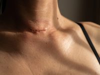 surgical scar on a woman neck after thyroid surgery
